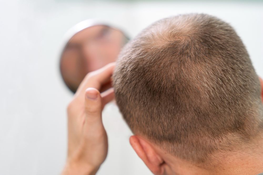 ADN CAPILAR CARGA GENETICA ASOCIADA A ALOPECIA