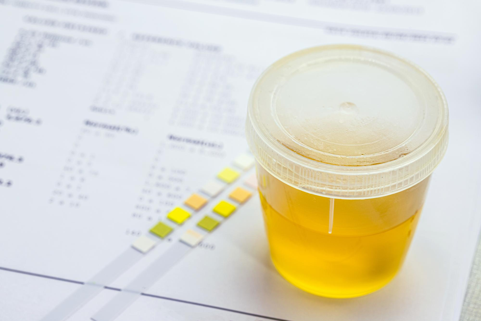 BENZODIAZEPINAS ORINA (DETECCION DE METABOLITOS)